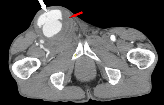 figure 6 Axial CT w_c showing the patent portion of the aneurysm containing contrast and clotted portion of the pseudoaneurysm
