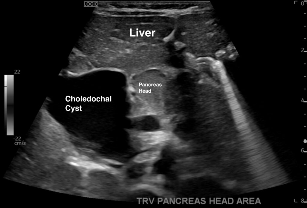 FIGURE 2 Panc TRV 6 Ultrasound 2