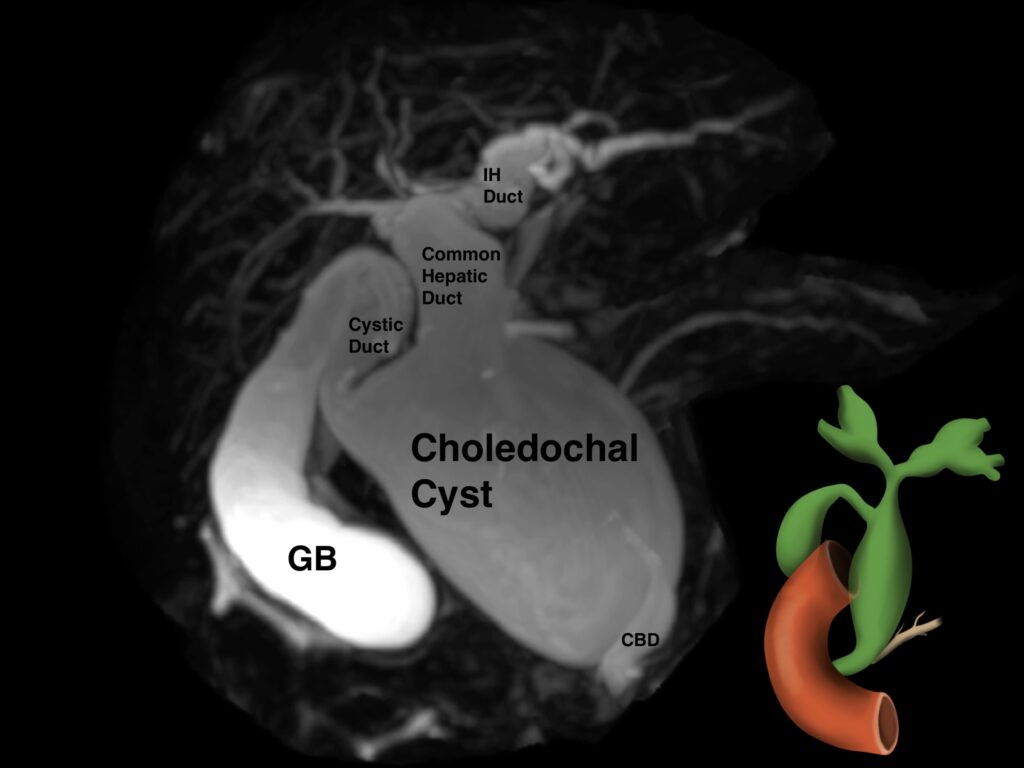 FIGURE 3 Type 4 Choledochal Cyst