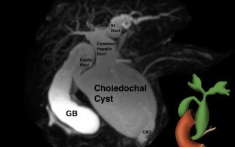 What Etiology of Clay-colored Stools in a Pediatric Patient?