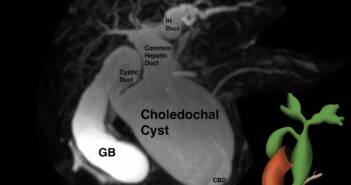 FIGURE 3 Type 4 Choledochal Cyst