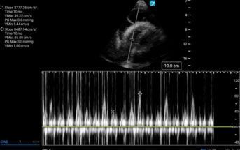 Op-Ed: Why Sensitivity Matters More Than Specificity in Identifying Pericardial Tamponade